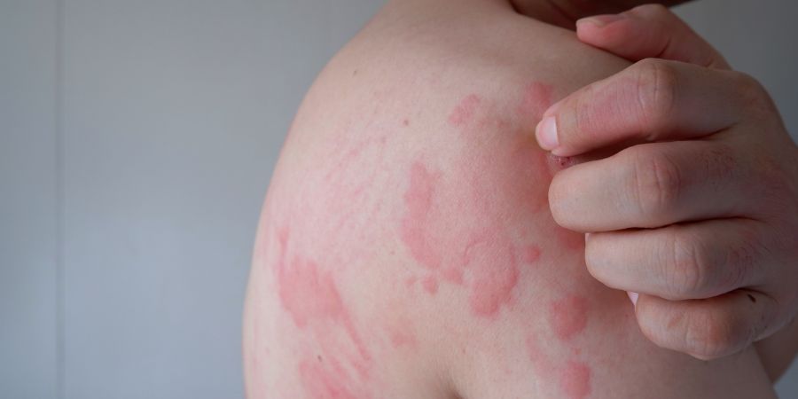 Close up image of skin texture suffering severe urticaria or hives or kaligata on back. Allergy symptoms. Skin consultant skin conditions article.