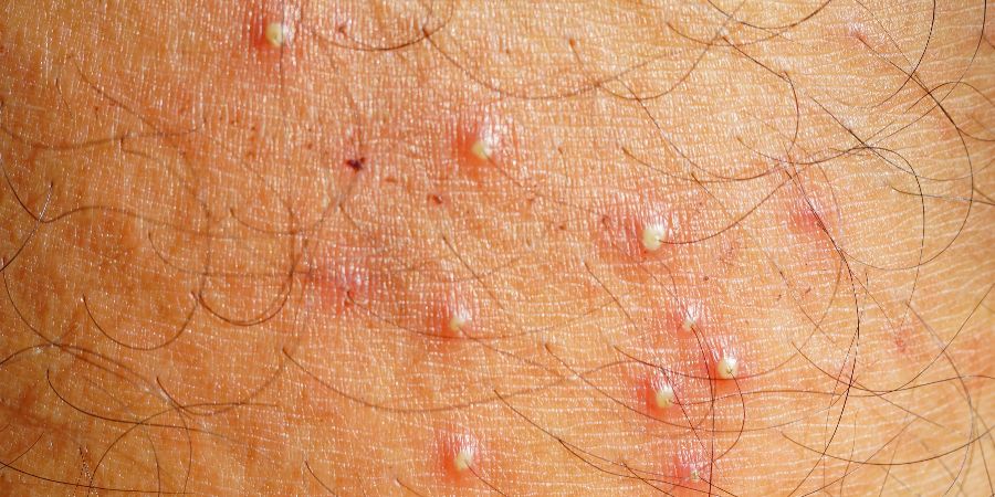 Folliculitis Inflammatory glands or inflammatory follicles. Skincare consultant skin conditions article.