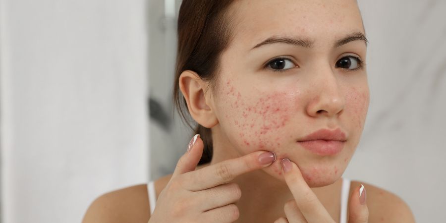 Teen girl with acne problem squeezing pimple indoors. Skincare consultant skin conditions article.