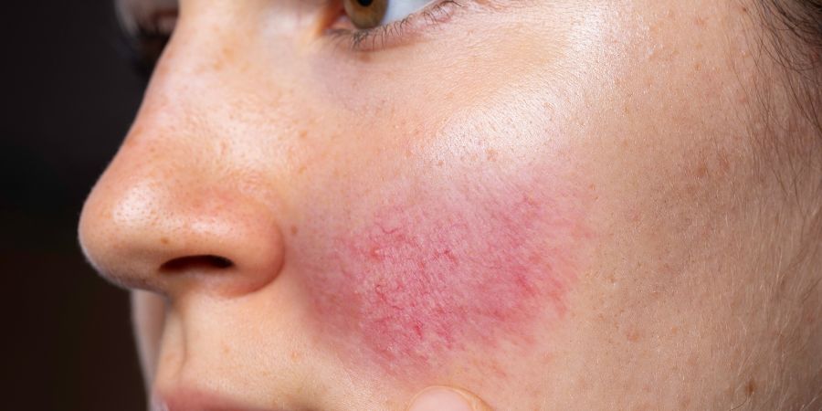 Skin conditions you'll see as a skincare consultant in-post image 3