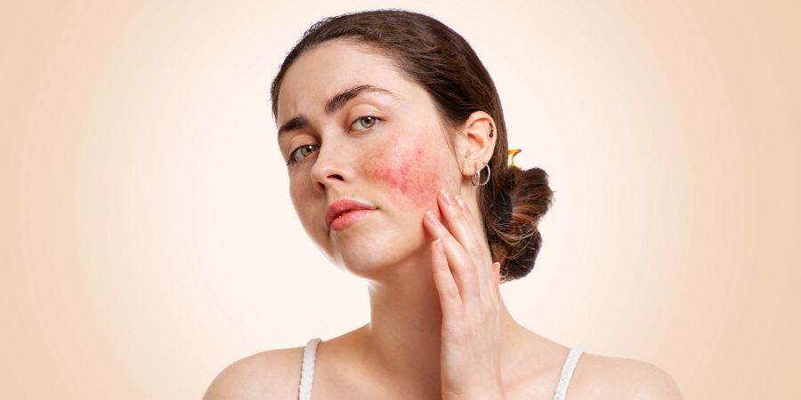 Portrait of a young pretty Caucasian woman who frowns and shows reddened and inflamed cheeks. Beige background. Copy space. The concept of rosacea, healthcare and couperose. Skincare consultant skin conditions article.