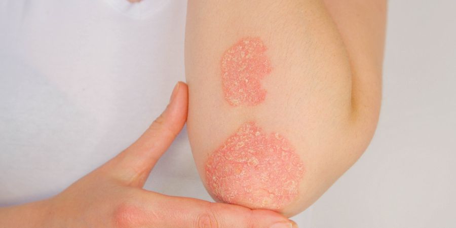 CLOSE UP: Unrecognizable young woman suffering from autoimmune incurable dermatological skin disease called psoriasis. Large red, inflamed, flaky rash on elbows. Joints affected by psoriatic arthritis. Skincare consultant skin conditions article.