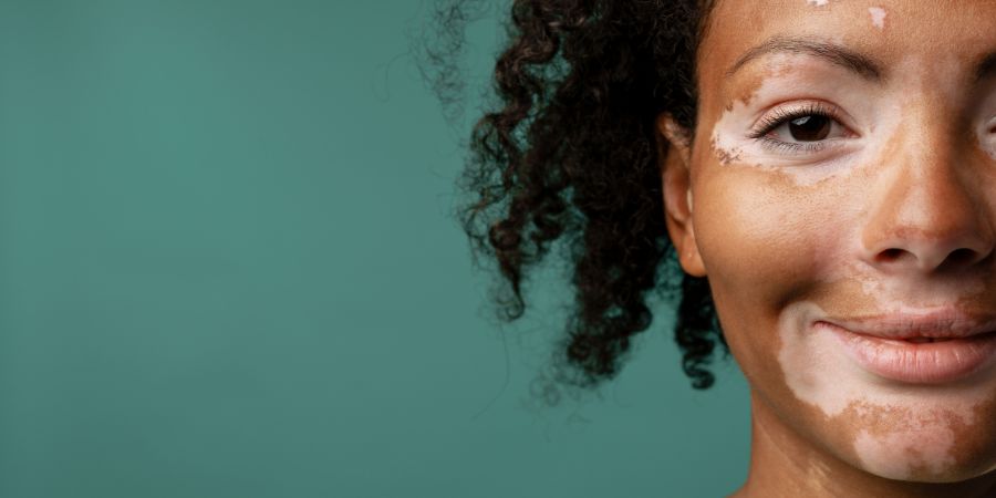 Portrait of a smiling young african casual woman with vitiligo condition standing over green background looking at camera close up. Skin consultant skin conditions article.